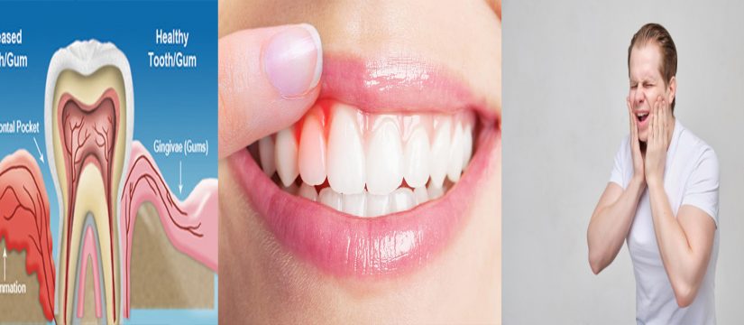 five signs of gum diseases