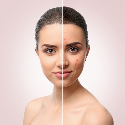 Acne Treatment Before and After