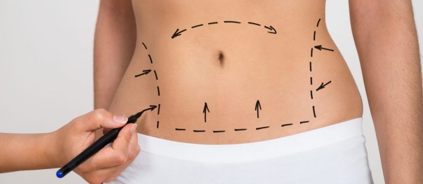 Fattan Polyclinic - Abdominal Liposuction Dubai process of drawing the image on the stomach to reflect the fat removal areas