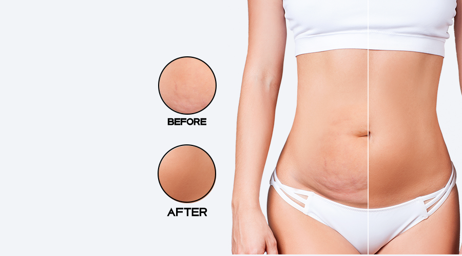 Fattan Polyclinic - Abdominal liposuction Dubai | Before and after results image