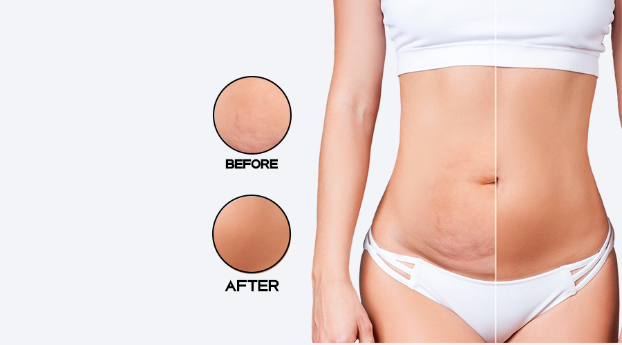 M&D Ab Lipo Abdominal Board Post Surgery Liposuction Tabla Abdominal Beige  in Dubai - UAE