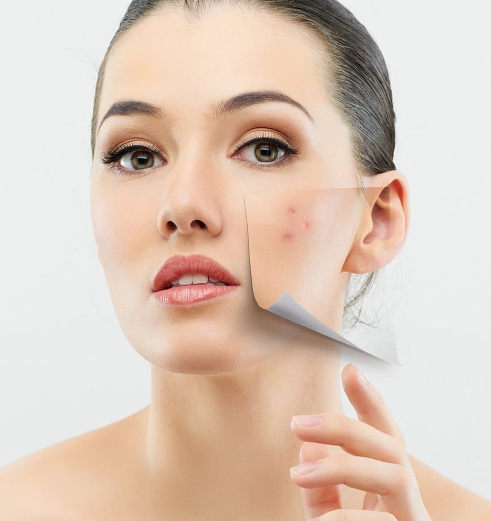 prp acne scars Treatment in Dubai