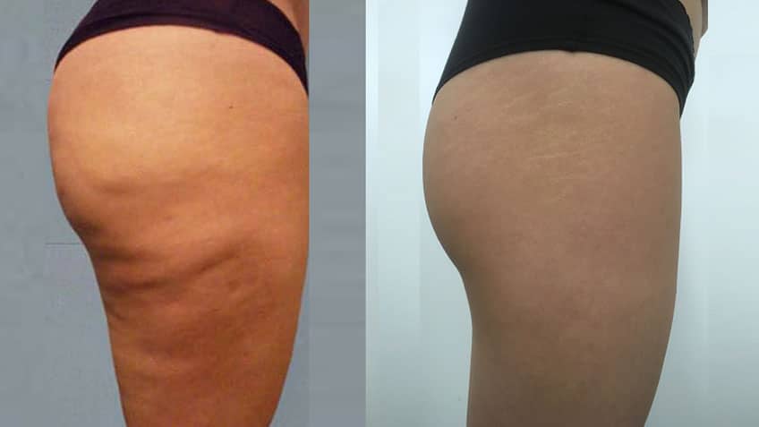 Comparison-between-cellulite-and-stretch-marks-for-removal
