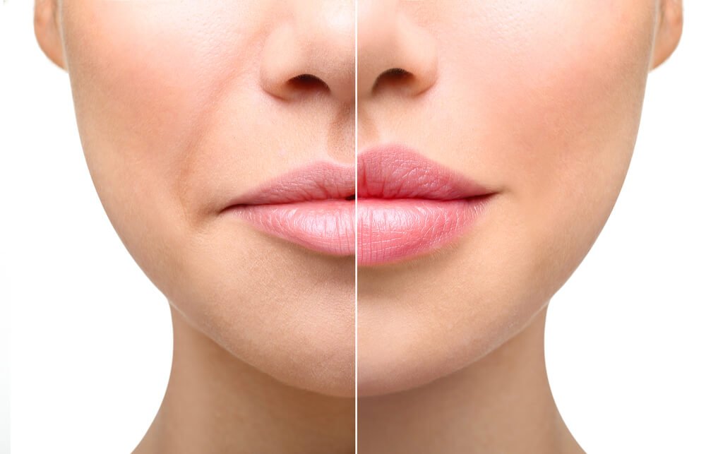 Get the Best Aesthetic Dermatology for Lip Filler in Dubai