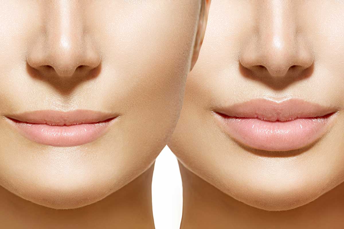 lip-filler-main