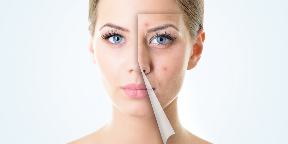 prp acne scars Treatment