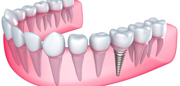 Dental implants in Abu Dhabi Best Dental Implant Clinic in Abu Dhabi