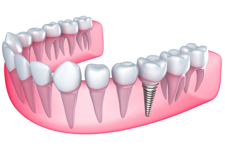 Dental implants in Abu Dhabi Best Dental Implant Clinic in Abu Dhabi