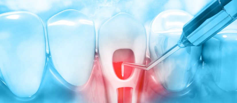 Laser Dentistry in Endodontic Treatments 1