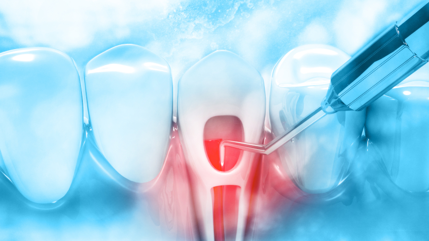 Laser Dentistry in Endodontic Treatments 1
