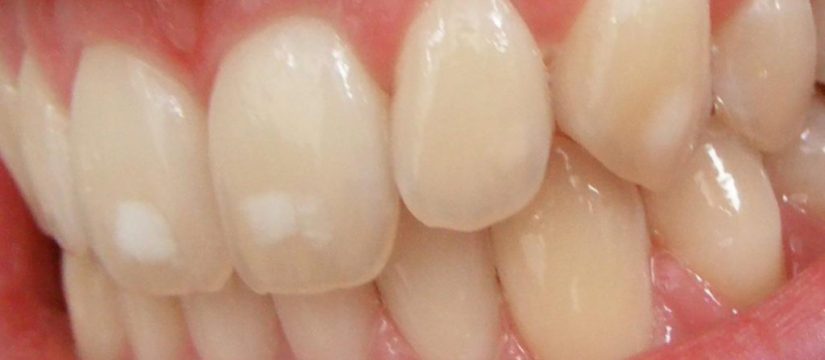 dental fluorosis br image credit matthew ferguson 57 2015 br 1024x575 1