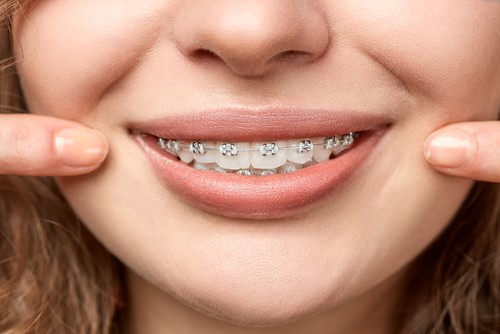 cost effective for standard dental braces