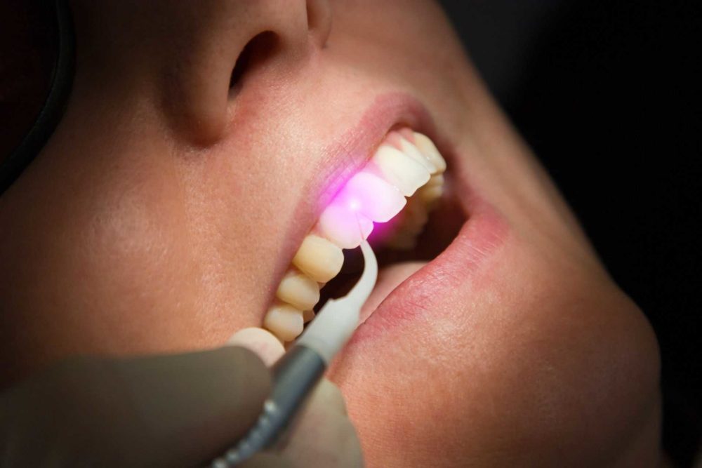 laser dentistry e1588763451140