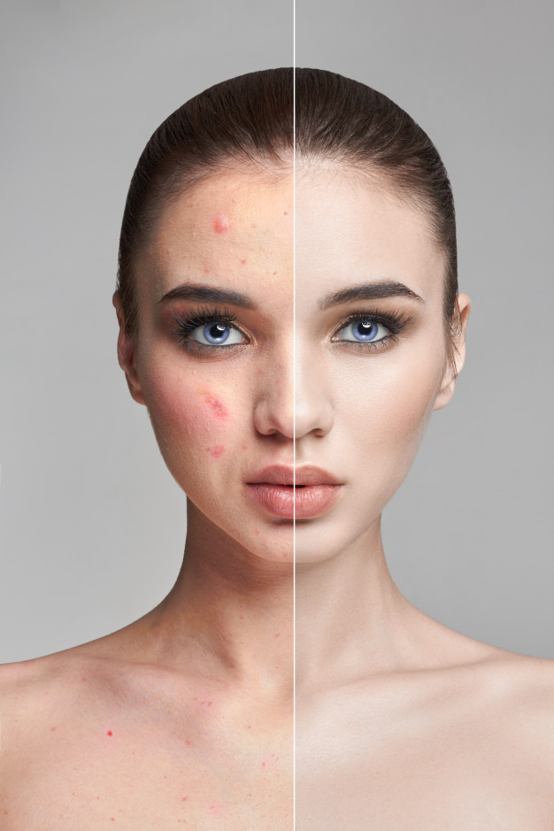 AFFIRM LASER Technology for acne treatment