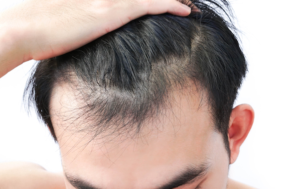 PRP Treatment, Close-Up Of Man With Receding Hairline Against White Background