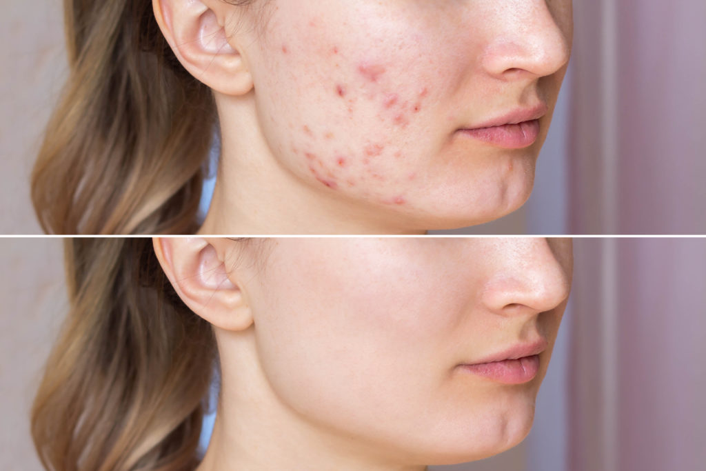 cropped shot young woman s face before after acne treatment face z 1024x683 1