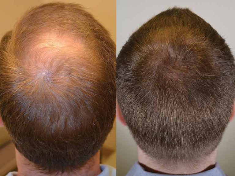 Hair Growth Before and after Results