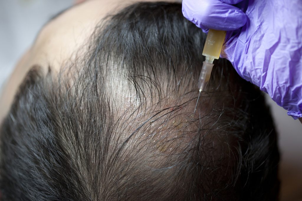 PRP Man Hair Loss Treatment in Dubai