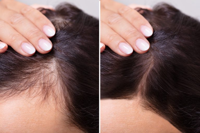 Best Hair Loss Treatments in Dubai